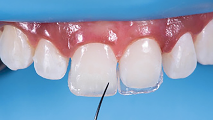 Close-up of composite bonding being applied to a front tooth